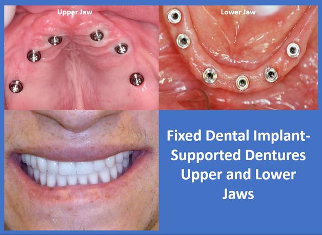 implant supported dentures