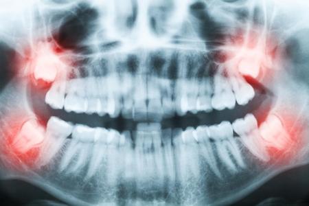 dental wisdom teeth extraction Brossard-Laprairie