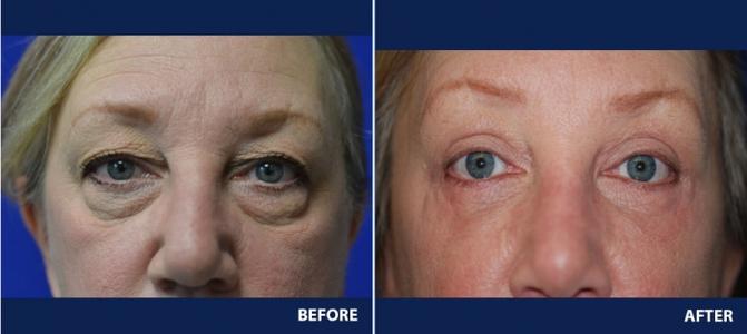 Eyelid Surgery Ft Myers FL - Blepharoplasty Cape Coral