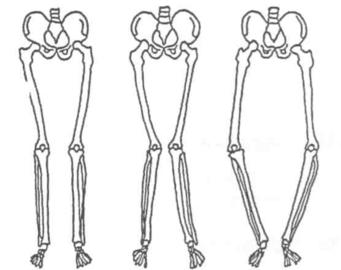 Adult Limb Deformity