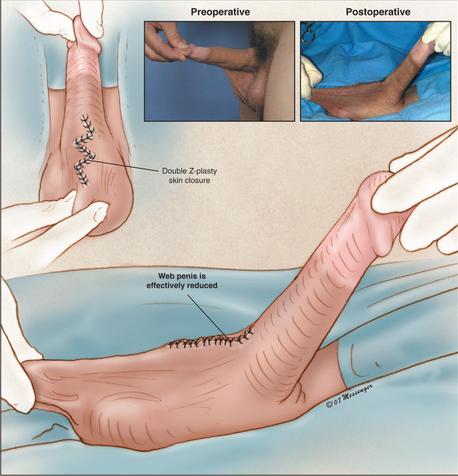 Penile lengthening