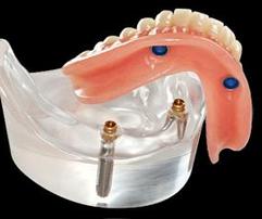 Denture On Implants Michel Puertas Denturologiste Brossard-Laprairie