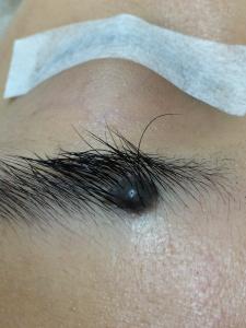 一粒部分生長在眉毛內，深黑色的，凸出的，大墨痣