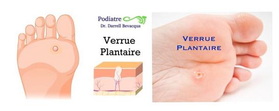 Verrue Plantaire Sur Le Gros Orteil Le Noir évident Pointille Des