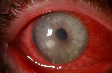 CORNEAL DISEASES and ULCER – Causes and Risk Factors, Clinical Manifestations and Management