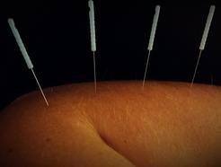 Acupuncture