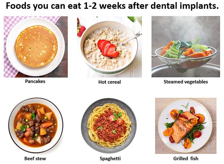 How To Transition To A Soft Diet After Dental Implants