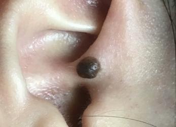 a dark brown protruding mole locates on the crus of the helix near the ear canal