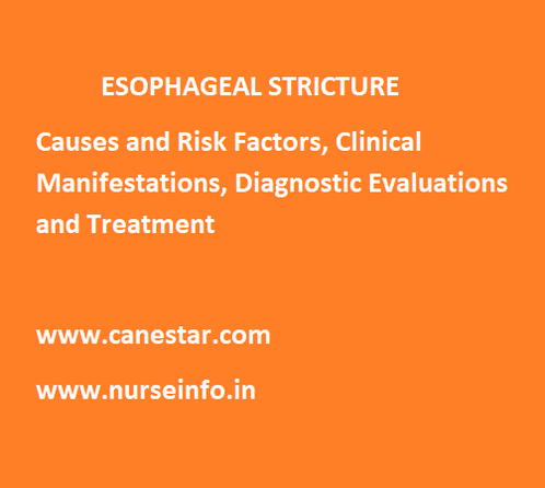 ESOPHAGEAL STRICTURE – Causes and Risk Factors, Clinical Manifestations, Diagnostic Evaluations and Treatment