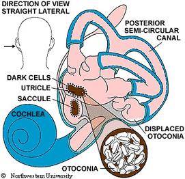 BPPV positional vertigo easily cured | BalanceMD