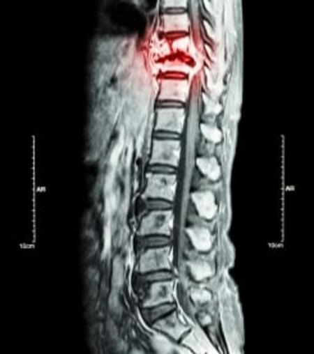 SPINAL CORD TUMORS – Types, Causes and Risk Factors, Clinical Manifestations, Diagnostic Evaluation and Management