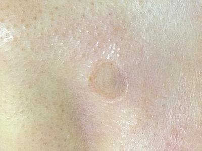 the appearance of the wound which is very tiny and superficial (nose)