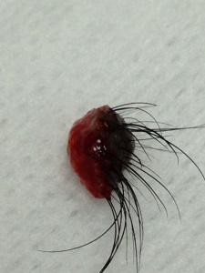 一粒已經被切了出來的，巨大的，有毛長出來的黑色的墨痣