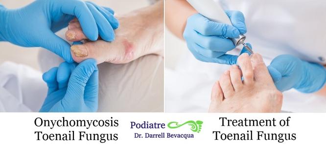 Athletes foot (Tinea pedis) Consult us for all fungal problems of