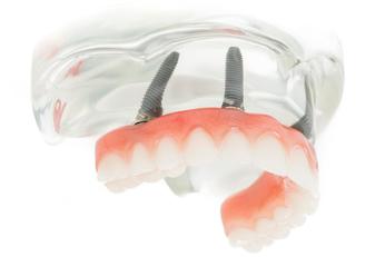 Prothèse Dentaire Fixe Sur Implants Fix-On-4 Michel Puertas Denturologiste Brossard-Laprairie, Fixed Denture On Implants Fix-On-4 Michel Puertas Denturologiste Brossard-Laprairie