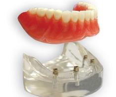 Denture On Implants Michel Puertas Denturologiste Brossard-Laprairie