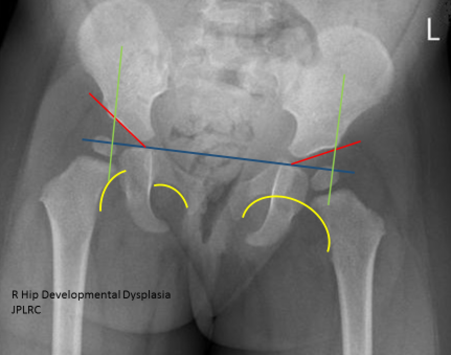 Developmental Hip Dysplasia DDH