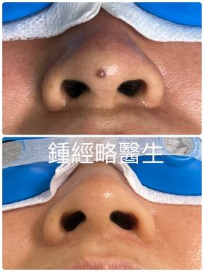 a before and after picture of removal of a brown skin mole on tip of nose