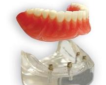 Prothèse Dentaire Sur Implants Michel Puertas Denturologiste Brossard-Laprairie, Denture On Implants Michel Puertas Denturologiste Brossard-Laprairie