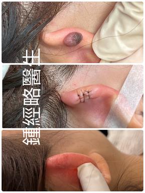 a serial of pictures of the process of removal of a dark brown skin mole on the spine of the helix of ear