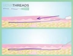 Cosmetic Injectables Center, Encino, Sherman Oaks Botox, Fillers, Restylane, Juvaderm, Novathreads, Collagen Stimulation, Skin