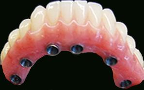 Prothèse Dentaire Fixe Sur Implants Michel Puertas Denturologiste Brossard-Laprairie, Fixed Denture On Implants Michel Puertas Denturologiste Brossard-Laprairie