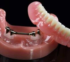 "Dental complete lower denture on 4 dental implants Brossard-Laprairie