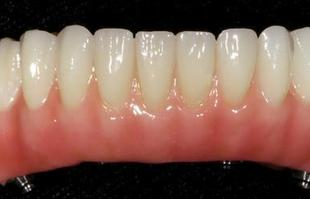 Denture Fix-On-Zircon Michel Puertas Denturologiste Brossard-Laprairie