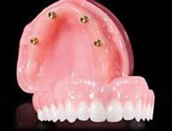 Prothèse Dentaire Sur Implants Michel Puertas Denturologiste Brossard-Laprairie, Denture On Implants Michel Puertas Denturologiste Brossard-Laprairie