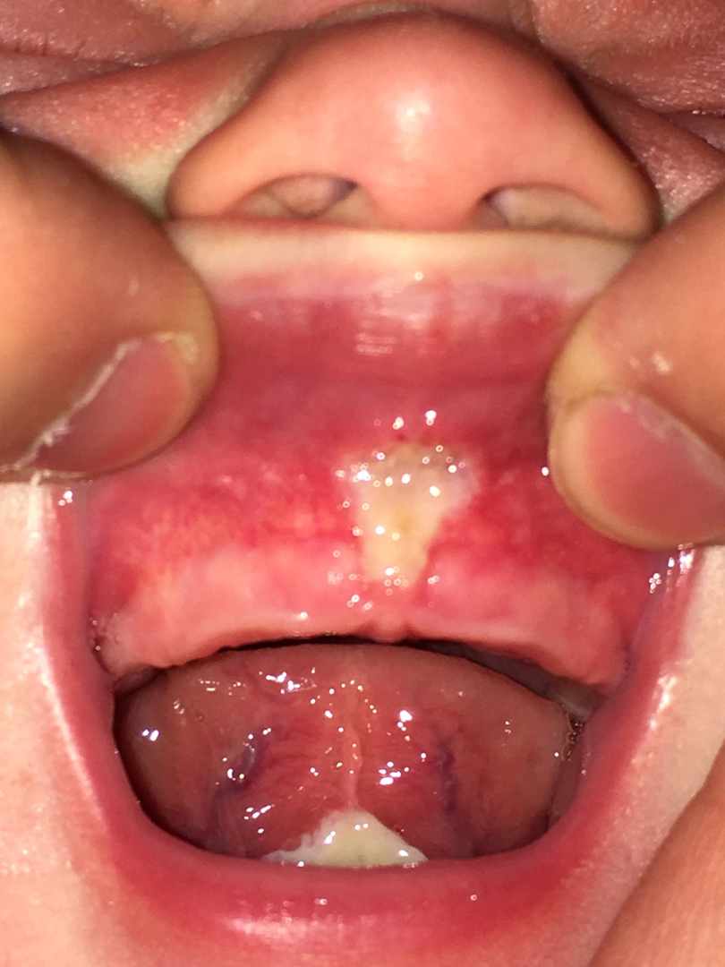 labial frenulum tear