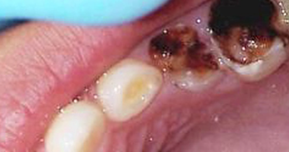 Bad Teeth - Dr. Joel Wallach