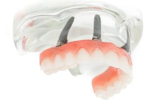 Prothèse Dentaire Fixe Sur Implants Fix-On-4 Michel Puertas Denturologiste Brossard-Laprairie, Fixed Denture On Implants Fix-On-4 Michel Puertas Denturologiste Brossard-Laprairie