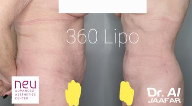 Liposuction before and after photos