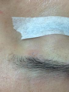 脫墨後位於上眼皮，接近眼眉毛的，不明顯的疤痕