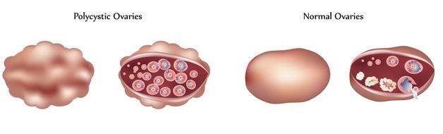best pcos treatment in vasco