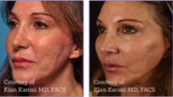 PRP, PRF, Vampire facial, microneedling, collagen, skin, tightening, fine lines, wrinkles, Encino, Cosmetic Injectables Center