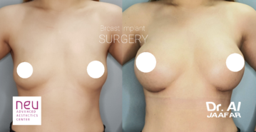 Breast implants before and after photos
