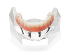 Prothèse Dentaire Fixe Sur Implants Michel Puertas Denturologiste Brossard-Laprairie, Fixed Denture On Implants Michel Puertas Denturologiste Brossard-Laprairie