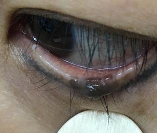 a black hairy mole on the margin of left lower eyelid