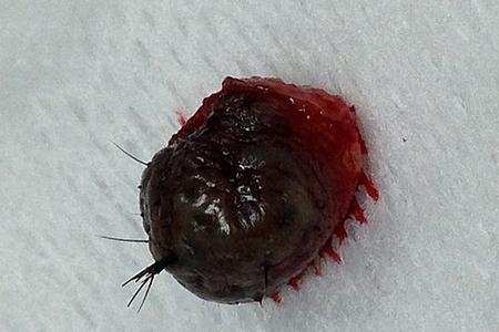 a large hairy black skin mole which is already been excised from the face and is put on a piece of gauze