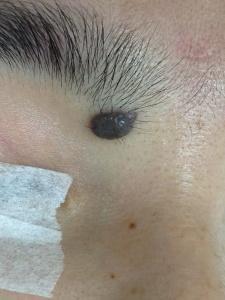 a black oval shaped protruding mole located under the medial end of left eyebrow