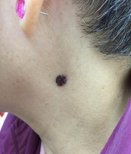 skin cancer on neck