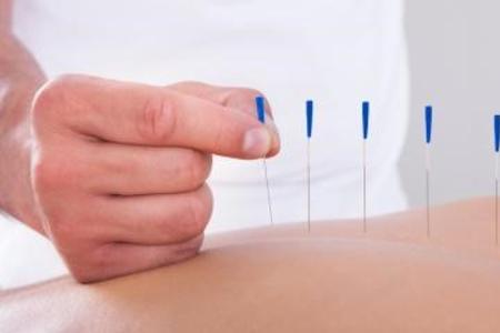 acupuncturist inserts needles into body