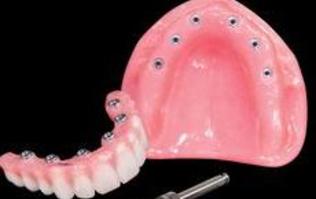 Fixed Denture On Implants Michel Puertas Denturologiste Brossard-Laprairie