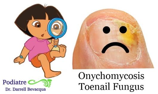 Athletes foot (Tinea pedis) Consult us for all fungal problems of