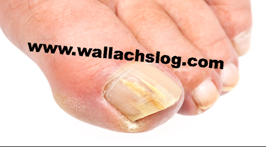 Toenail Fungus - Dr. Joel Wallach