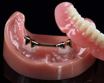 prothèse amovible sur implants removable denture on implants Brossard-Laprairie