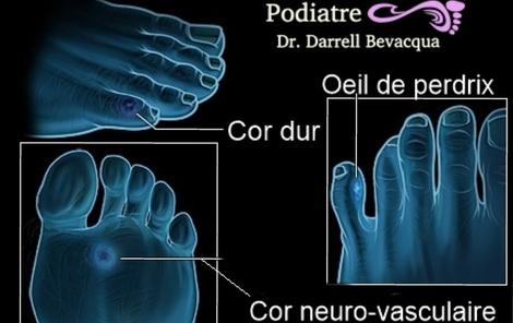 bunions corns calluses