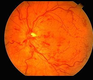 Retinal Photography