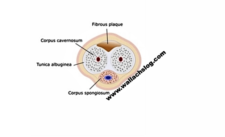 Peyronie's Disease - Dr. Joel Wallach